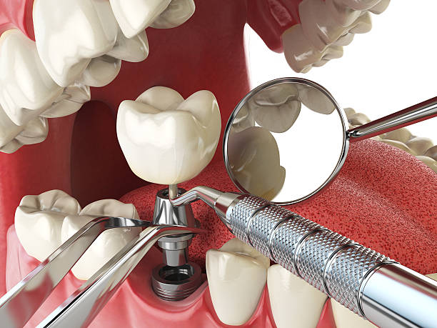 Best Emergency Wisdom Tooth Extraction in Butler, GA